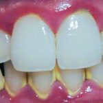 Cara Merontokkan Karang Gigi Secara Alami Ketahui Penyebabnya