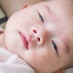 Cara Menghilangkan Bruntusan Pada Wajah Bayi Secara Alami